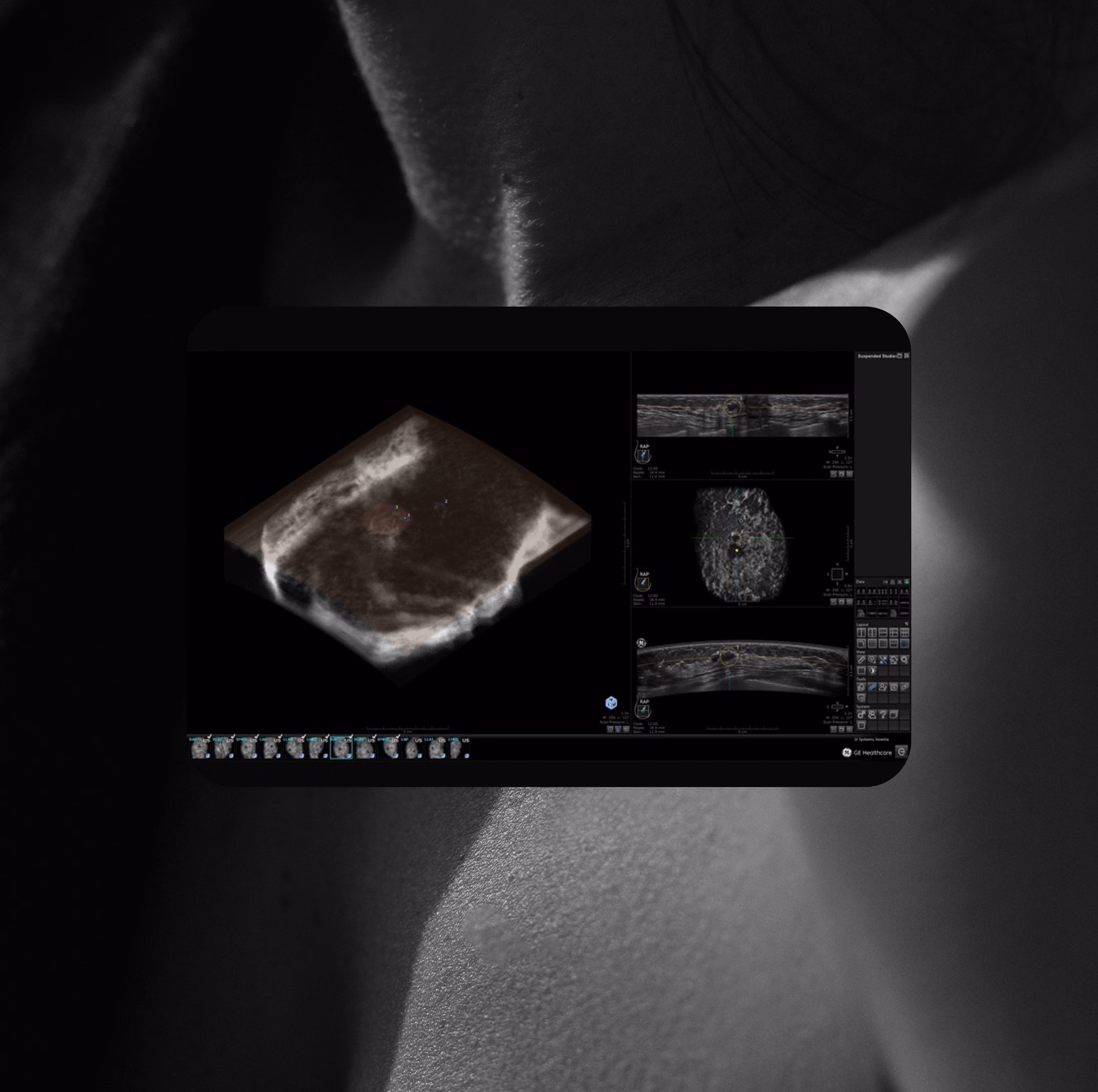 ABUS review workstation displaying a reconstructed 3D breast volume alongside coronal and cross-sectional ultrasound views